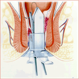 hemorroidectomia PPH