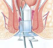 Circular stapler for the surgical treatment of hemorrhoids