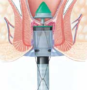 surgical stapler for hemorrhoids 