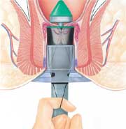 surgical staplers for hemorrhoids